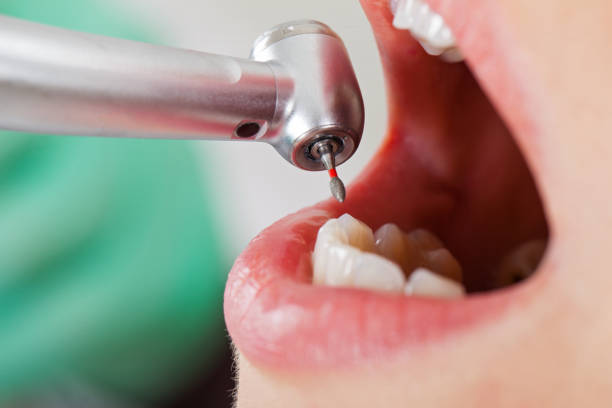 Best Emergency Tooth Extraction in Mcewen, TN